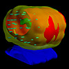 3D-Ansicht der Dosisverteilung während der intraoperativen Bestrahlungsplanung