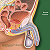 Normale Anatomie der Prostata