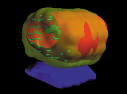 3D-Ansicht der Dosisverteilung während der intraoperativen Bestrahlungsplanung